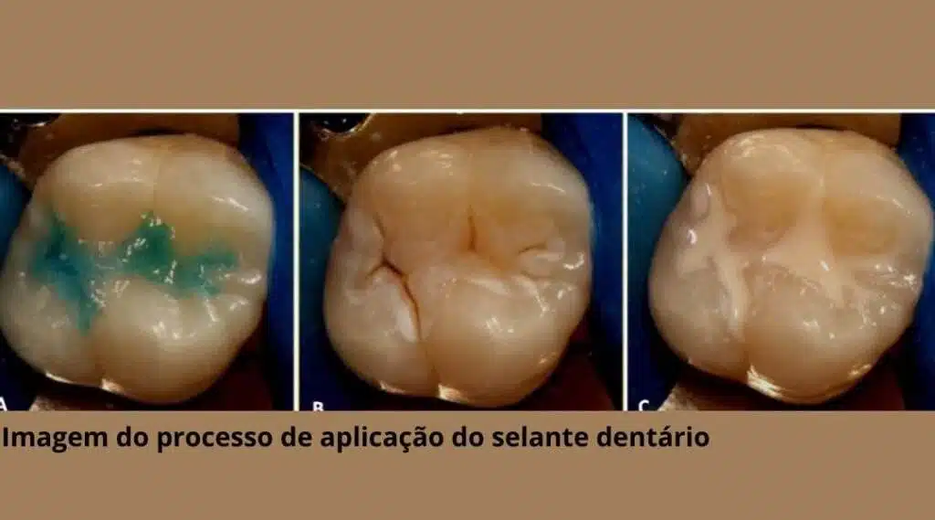 Dental Sealant Application Process
