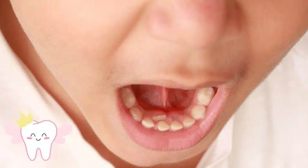 Baby Tooth Loss