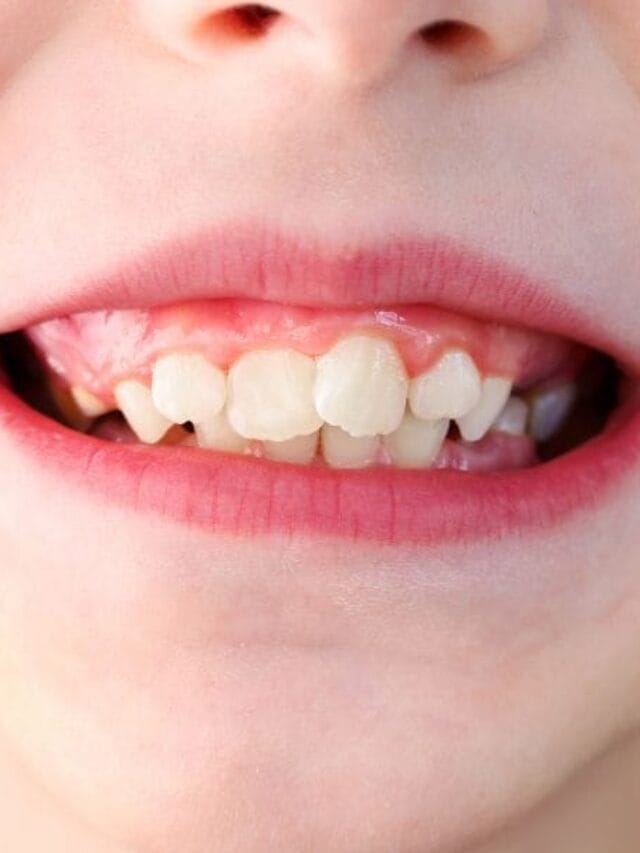 Dentes Tortos