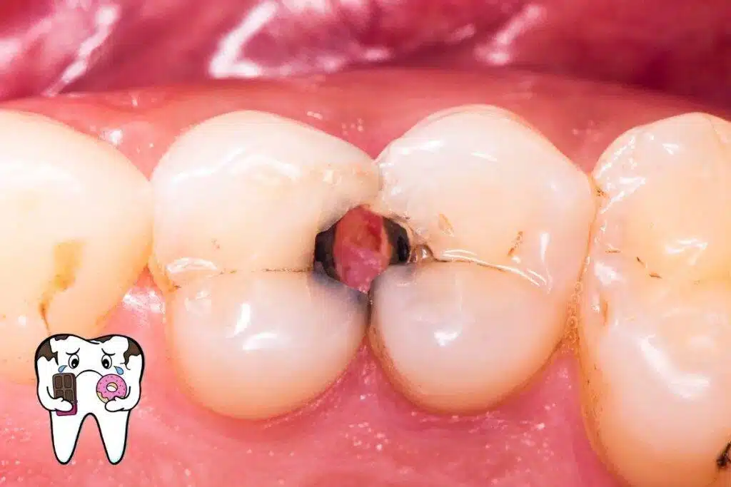 Dentes Cariados