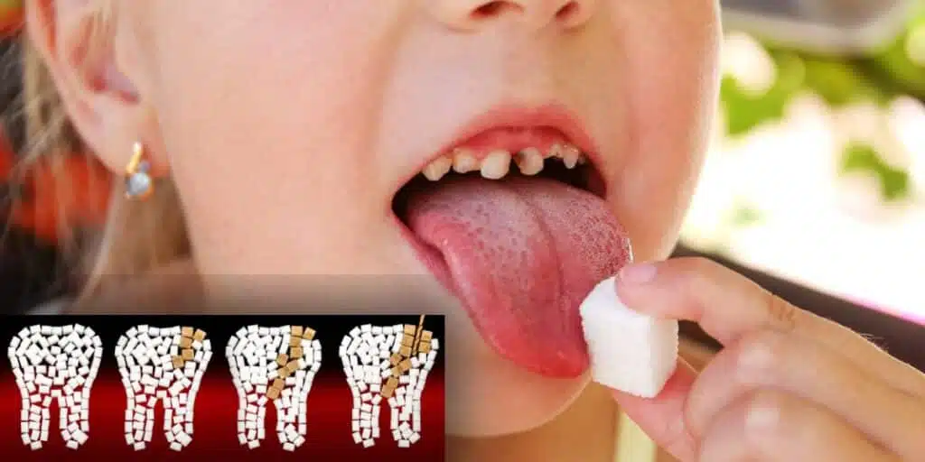 Suggar and Cavities