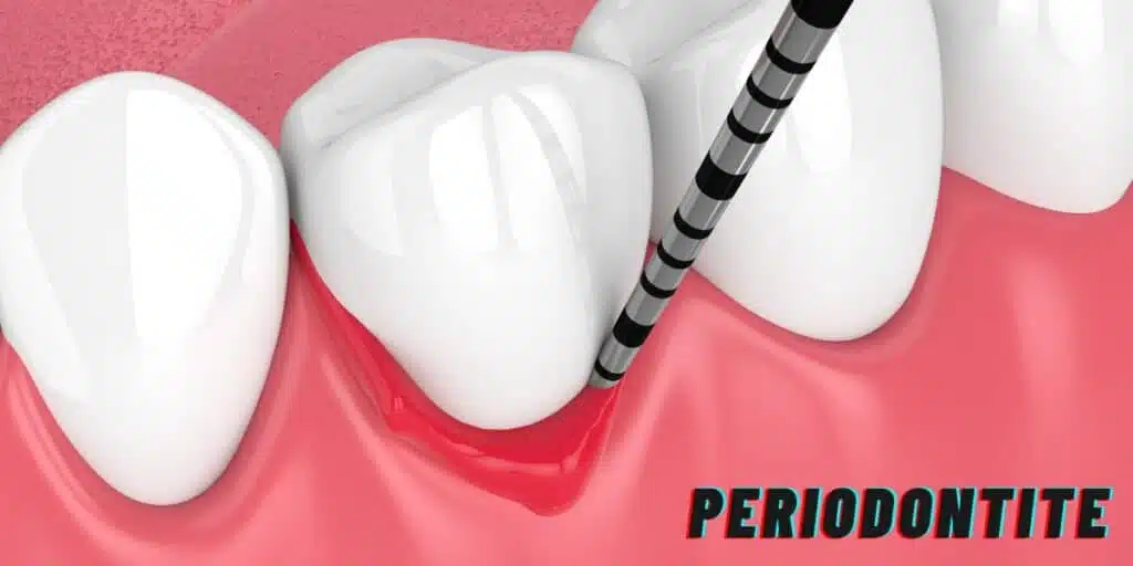 Periodontitis