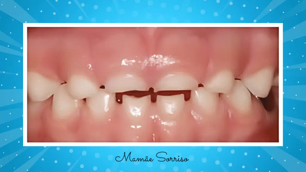 boca de uma criança com bruxismo, apresentando desgaste dos dentes.