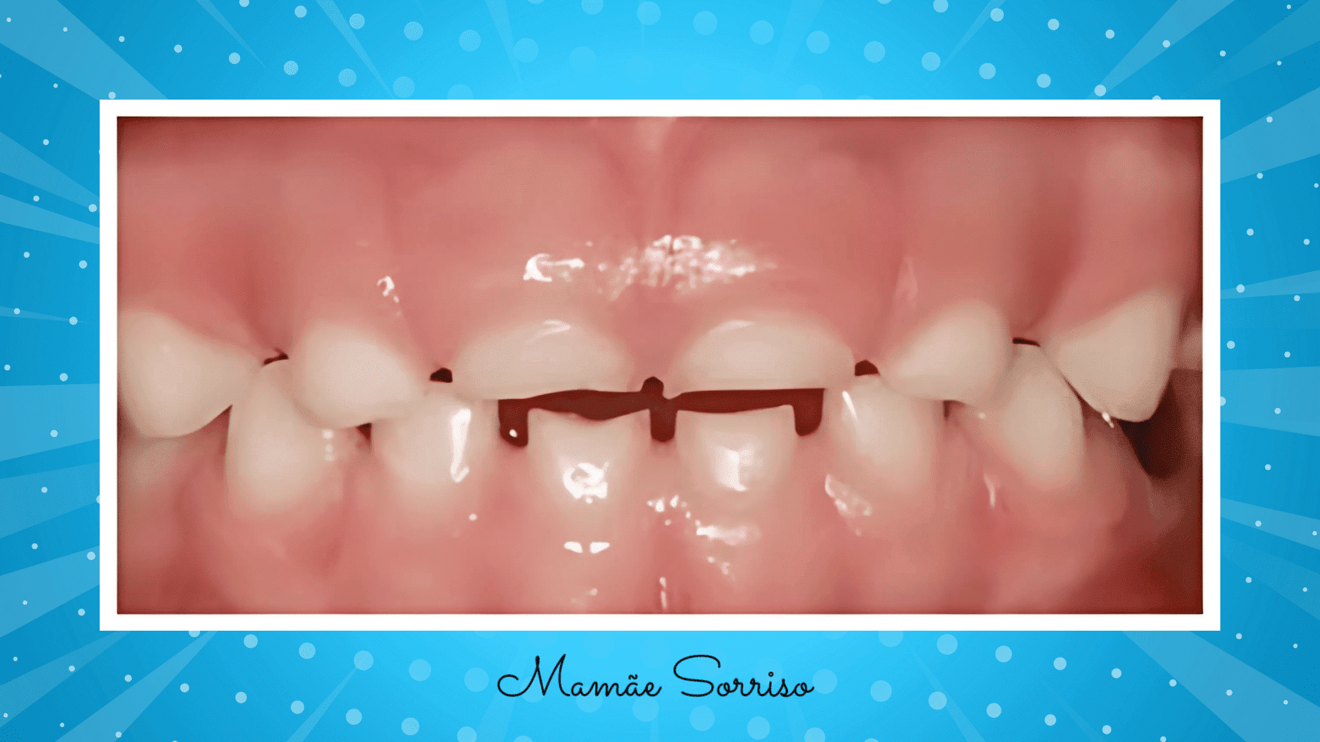 boca de uma criança com bruxismo, apresentando desgaste dos dentes.