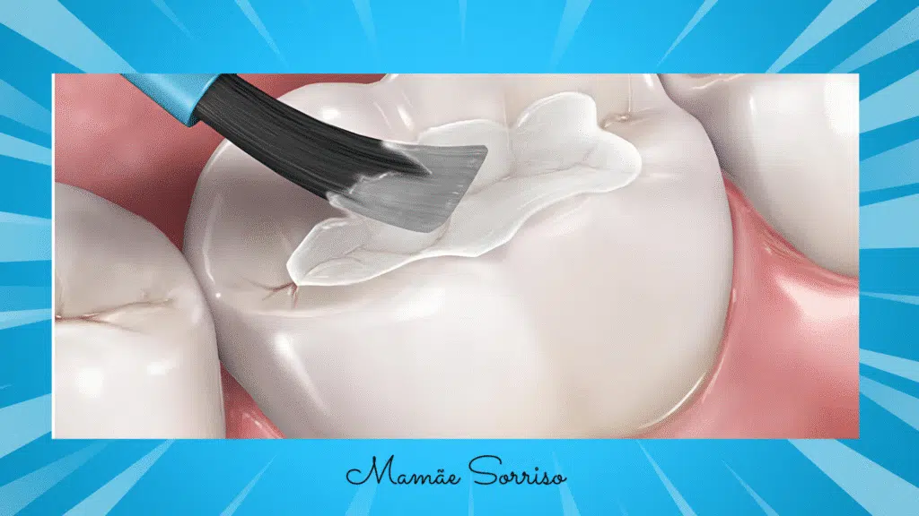 Illustration of a tooth receiving the application of a dental sealant.