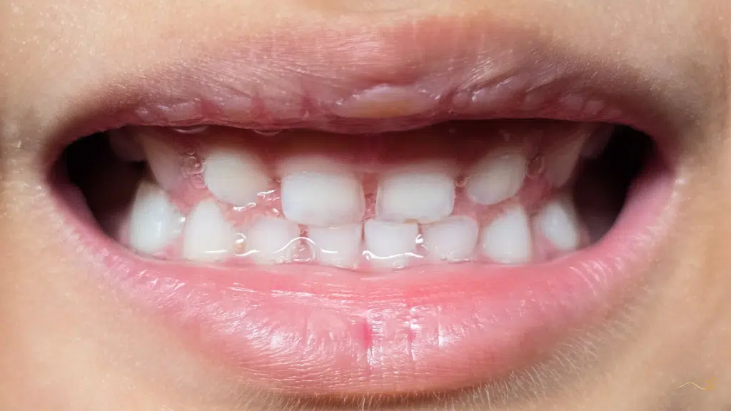 criança com má oclusão dentária